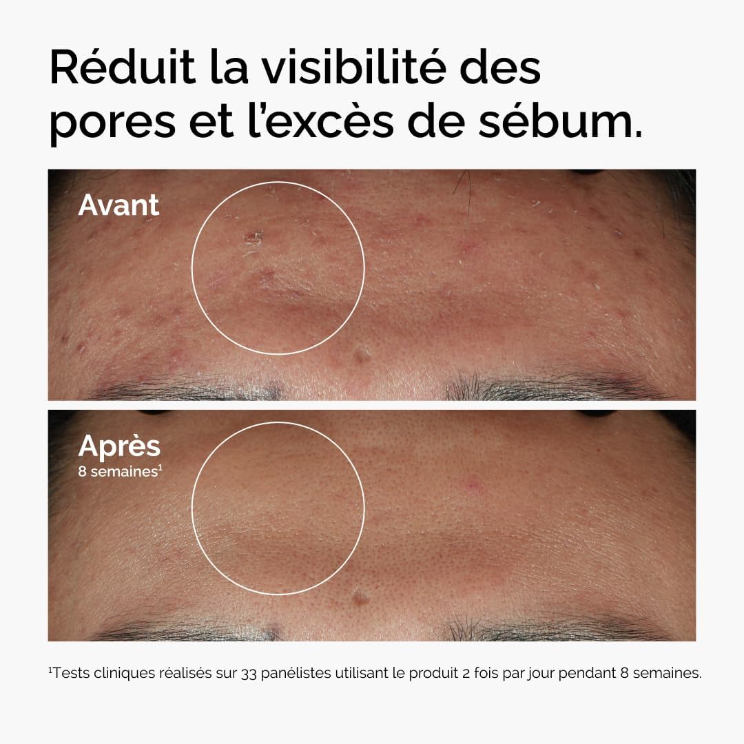 The Ordinary Niacinamide 10% + Zinc 1% - Sérum Anti - Imperfections 30ml - Home Chic Choc30 ml (Lot de 1)